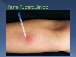 Isso baseia-se no fato de que a
Infecção pelo BK produz uma
reação
De hipersensibilidade a certos
componentes antigênicos,
Neste caso a tuberculina
Dose 0,1ml
 