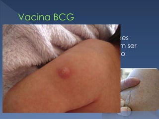  Os Recém-nascidos filhos de mães
soropositivas ou com AIDS devem ser
vacinados, desde que sejam não
reatoras à prova tuberculínica.
 