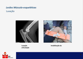 Luxação Imobilização da
articulação
Luxação
Lesões Músculo-esqueléticas
 