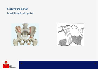 Fratura de pelve
Imobilização da pelve
 