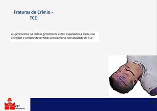 Os ferimentos no crânio geralmente estão associados a lesões no
encéfalo e sempre deveremos considerar a possibilidade de TCE.
Fraturas de Crânio -
TCE
 