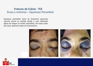 Fraturas de Crânio - TCE
Sinais e sintomas – Equimose Periorbital
Equimose periorbital (sinal de Guaxinim) apresenta
mancha escura ou azulada devida a uma infiltração
difusa de sangue no tecido subcutâneo. Na maior parte
dos casos, aparecem após um traumatismo.
 