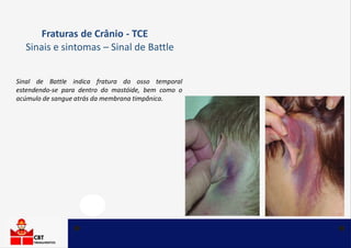 Fraturas de Crânio - TCE
Sinais e sintomas – Sinal de Battle
Sinal de Battle indica fratura do osso temporal
estendendo-se para dentro do mastóide, bem como o
acúmulo de sangue atrás da membrana timpânica.
 