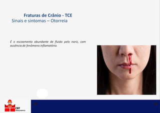 Fraturas de Crânio - TCE
Sinais e sintomas – Otorreia
É o escoamento abundante de fluido pelo nariz, com
ausência de fenômeno inflamatório.
 