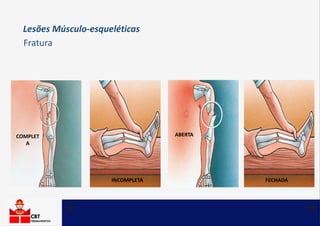 COMPLET
A
INCOMPLETA
ABERTA
FECHADA
Lesões Músculo-esqueléticas
Fratura
 