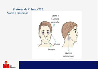 Fraturas de Crânio - TCE
Sinais e sintomas – Equimose Periorbital
Equimose periorbital (sinal de Guaxinim) apresenta
manch...