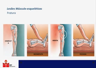 Lesões Músculo-esqueléticas
Fratura
As fraturas geralmente ocorrem em virtude de algum impacto,
queda ou esmagamento, send...