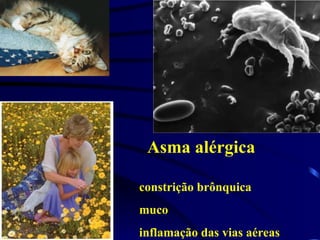 Asma alérgica
constrição brônquica
muco
inflamação das vias aéreas
 
