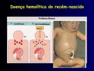 Doença hemolítica do recém-nascido
 