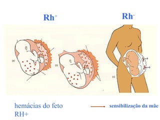 Rh+ Rh-
sensibilização da mãe
hemácias do feto
RH+
 