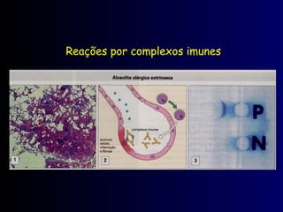 Reações por complexos imunes
 