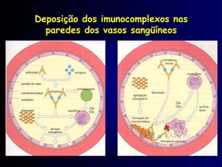 Deposição dos imunocomplexos nas
paredes dos vasos sangüíneos
 