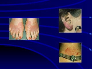 Hipersensibilidade do tipo IV
Dermatite de Contato por
sensibilização com material de calçado
Dermatite de contato alérgica
Dermatite de contato alérgica
DERMATITE DE CONTATO
 