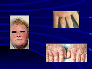 Hipersensibilidade do tipo IV
fotodermatite
Dermatite de contato
alérgica
Dermatite de Contato por
irritante primário - sabões
DERMATITE DE CONTATO
 