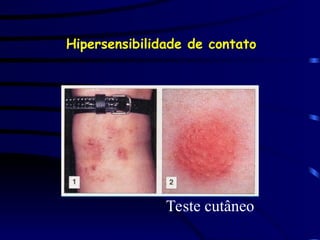 Hipersensibilidade de contato
Teste cutâneo
 