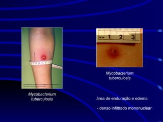 Mycobacterium
tuberculosis
REAÇÃO TUBERCULÍNICA
Mycobacterium
tuberculosis
- denso infiltrado mononuclear
- área de enduração e edema
Hipersensibilidade do tipo IV
 