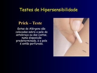 Testes de Hipersensibilidade
Prick – Teste
Gotas do Alérgeno são
colocadas sobre a pele do
antebraço ou das costas,
numa disposição
predeterminada, e a pele
é então perfurada.
 
