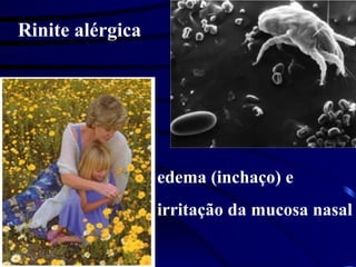 Rinite alérgica
edema (inchaço) e
irritação da mucosa nasal
 