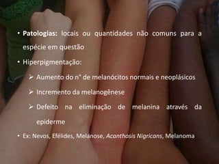 • Patologias: locais ou quantidades não comuns para a
espécie em questão
• Hiperpigmentação:
 Aumento do n° de melanócitos normais e neoplásicos
 Incremento da melanogênese
 Defeito na eliminação de melanina através da
epiderme
• Ex: Nevos, Efélides, Melanose, Acanthosis Nigricans, Melanoma
 