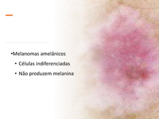 •Melanomas amelânicos
• Células indiferenciadas
• Não produzem melanina
 