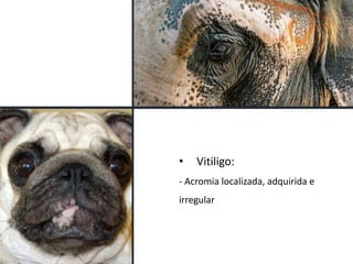 • Vitiligo:
- Acromia localizada, adquirida e
irregular
 