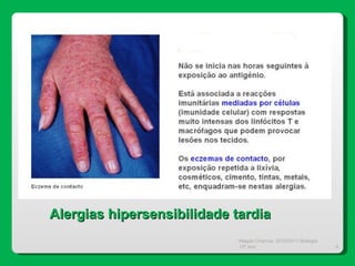Magda Charrua  2010/2011 Biologia 12º ano  Alergias hipersensibilidade tardia 