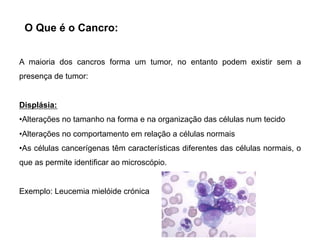 A maioria dos cancros forma um tumor, no entanto podem existir sem a
presença de tumor:
Displásia:
•Alterações no tamanho na forma e na organização das células num tecido
•Alterações no comportamento em relação a células normais
•As células cancerígenas têm características diferentes das células normais, o
que as permite identificar ao microscópio.
Exemplo: Leucemia mielóide crónica
O Que é o Cancro:
 