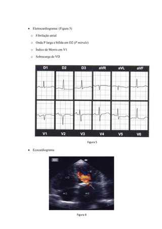 • Eletrocardiograma: (Figura 5)
o Fibrilação atrial
o Onda P larga e bífida em D2 (P mitrale)
o Índice de Morris em V1
o Sobrecarga de VD
• Ecocardiograma
Figura 5
Figura 6
 