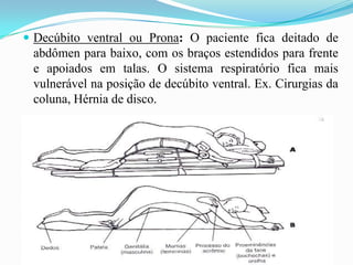  Decúbito ventral ou Prona: O paciente fica deitado de
abdômen para baixo, com os braços estendidos para frente
e apoiados em talas. O sistema respiratório fica mais
vulnerável na posição de decúbito ventral. Ex. Cirurgias da
coluna, Hérnia de disco.
 