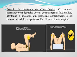  Posição de litotômia ou Ginecológica: O paciente
permanece em decúbito dorsal, com as pernas flexionadas,
afastadas e apoiadas em perneiras acolchoadas, e os
braços estendidos e apoiados. Ex. Histerectomia vaginal.
 