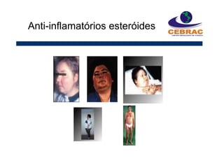 Anti-inflamatórios esteróides
 