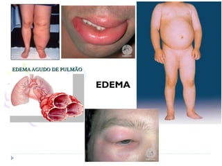 EDEMA
 