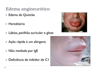 Edema angineurótico
 Edema de Quincke
 Hereditário
 Lábios, pavilhão auricular e glote
 Ação rápida à um alérgeno
 Não mediada por IgE
 Deficiência de inibidor de C1
 