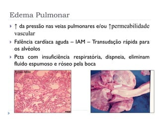 Edema Pulmonar
 ↑ da pressão nas veias pulmonares e/ou ↑permeabilidade
vascular
 Falência cardíaca aguda – IAM – Transudação rápida para
os alvéolos
 Pcts com insuficiência respiratória, dispneia, eliminam
fluido espumoso e róseo pela boca
 