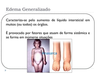 Edema Generalizado
Caracteriza-se pelo aumento de líquido intersticial em
muitos (ou todos) os órgãos.
É provocado por fatores que atuam de forma sistêmica e
se forma em inúmeras situações
 