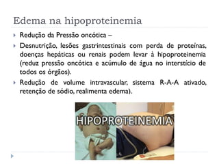 Edema na hipoproteinemia
 Redução da Pressão oncótica –
 Desnutrição, lesões gastrintestinais com perda de proteínas,
doenças hepáticas ou renais podem levar à hipoproteinemia
(reduz pressão oncótica e acúmulo de água no interstício de
todos os órgãos).
 Redução de volume intravascular, sistema R-A-A ativado,
retenção de sódio, realimenta edema).
 