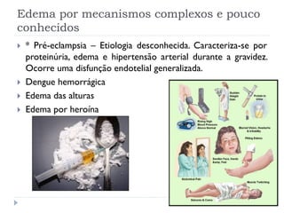 Edema por mecanismos complexos e pouco
conhecidos
 * Pré-eclampsia – Etiologia desconhecida. Caracteriza-se por
proteinúria, edema e hipertensão arterial durante a gravidez.
Ocorre uma disfunção endotelial generalizada.
 Dengue hemorrágica
 Edema das alturas
 Edema por heroína
 