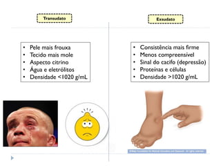 Transudato Exsudato
• Pele mais frouxa
• Tecido mais mole
• Aspecto citrino
• Água e eletrólitos
• Densidade <1020 g/mL
• Consistência mais firme
• Menos compreensível
• Sinal do cacifo (depressão)
• Proteínas e células
• Densidade >1020 g/mL
 