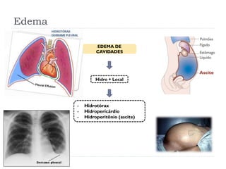 Edema
EDEMA DE
CAVIDADES
Hidro + Local
- Hidrotórax
- Hidropericárdio
- Hidroperitônio (ascite)
 
