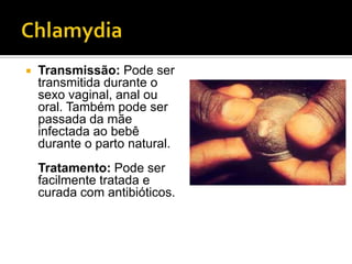 ChlamydiaTransmissão: Pode ser transmitida durante o sexo vaginal, anal ou oral. Também pode ser passada da mãe infectada ao bebê durante o parto natural.Tratamento: Pode ser facilmente tratada e curada com antibióticos.