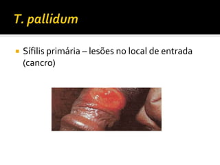 T. pallidumSífilis primária – lesões no local de entrada (cancro)