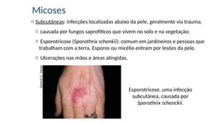 Micoses
o Subcutâneas: infecções localizadas abaixo da pele, geralmente via trauma.
o causada por fungos saprofíticos que vivem no solo e na vegetação;
o Esporotricose (Sporothrix schenkii): comum em jardineiros e pessoas que
trabalham com a terra. Esporos ou micélio entram por lesões da pele.
o Ulcerações nas mãos e áreas atingidas.
Esporotricose, uma infecção
subcutânea, causada por
Sporothrix schenckii.
 