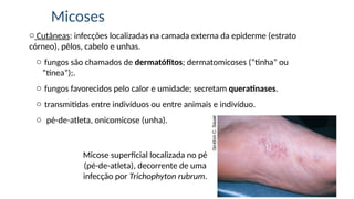 Micoses
o Cutâneas: infecções localizadas na camada externa da epiderme (estrato
córneo), pêlos, cabelo e unhas.
o fungos são chamados de dermatófitos; dermatomicoses (“tinha” ou
“tínea”);.
o fungos favorecidos pelo calor e umidade; secretam queratinases.
o transmitidas entre indivíduos ou entre animais e indivíduo.
o pé-de-atleta, onicomicose (unha).
Micose superficial localizada no pé
(pé-de-atleta), decorrente de uma
infecção por Trichophyton rubrum.
 