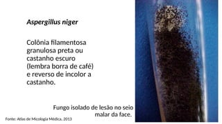 Fungo isolado de lesão no seio
malar da face.
Aspergillus niger
Colônia filamentosa
granulosa preta ou
castanho escuro
(lembra borra de café)
e reverso de incolor a
castanho.
Fonte: Atlas de Micologia Médica, 2013
 