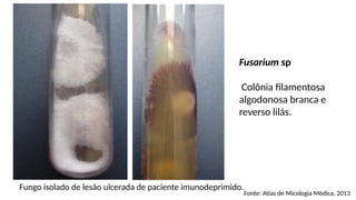 Fungo isolado de lesão ulcerada de paciente imunodeprimido.
Fusarium sp
Colônia filamentosa
algodonosa branca e
reverso lilás.
Fonte: Atlas de Micologia Médica, 2013
 
