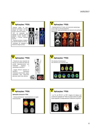 14/05/2017
4
Aplicações:
Aplicações: 18
18FDG
FDG
Paciente adulto do sexo
masculino submetido a remoção
cirúrgica de câncer de pele
primário (melanoma maligno).
PET (b) mostrando alta
captação de 18FDG nas áreas de
captação natural (cérebro e
bexiga) e tumores (manchas
escuras).
Presença de câncer no fígado e
em algumas regiões do músculo.
Resulttado de metástase do
melanoma maligno primário.
Aplicações:
Aplicações: 18
18FDG
FDG
Paciente feminino, 51 anos, com carcinoma nasofaríngeo.
(a) TC e PET no início do traamento
(b) TC e PET após quimioterapia com lipossoma de paclitaxel e
carboplatina.
a
b
Aplicações:
Aplicações: 18
18FDG
FDG
Paciente do sexo masculino de
69 anos com história de câncer de
pulmão (adenocarcinoma) com
metástases hepáticas e
subcutâneas (30/3/2012)
Imagem PET/CT realizada em
30/5/2012 demonstrou
metástases disseminadas: fígado,
subcutâneo, osso, supra-renal,
pâncreas, tecido mole, peritônio
Aplicações:
Aplicações: 18
18FDG
FDG
FTD: Demência frontotemporal
DLB: Demência com corpos de Lewy
Aplicações:
Aplicações: 18
18FDG
FDG
Aplicações clínicas de 18FDG
Doença de Alzheimer: hipometabolismo na região
temporoparietal.
Aplicações:
Aplicações: 18
18FDG
FDG
(a) TC; (b) PET/CT; (c) PET. Imagens de cabeça com
aumento da captação de 18FDG na porção anterior do globo
ocular esquerdo, correspondente ao melanoma conjuntival.
 