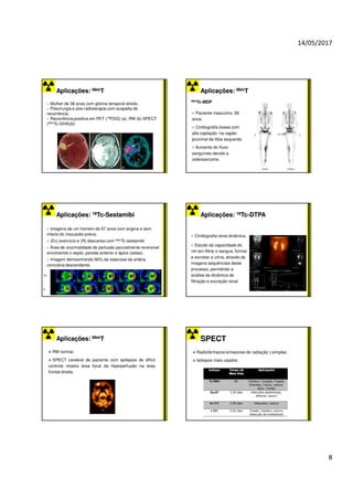 14/05/2017
8
Aplicações:
Aplicações: 99m
99mT
T
Mulher de 38 anos com glioma temporal direito.
Póscirurgia e pós-radioterapia com suspeita de
recorrência.
Recorrência positiva em PET (18FDG) (a), RM (b) SPECT
(99mTc-GHA)(b)
d
Aplicações:
Aplicações: 99m
99mT
T
99mTc-MDP
d
Paciente masculino, 58
anos.
Cintilografia óssea com
alta captação na ragião
proximal da tíbia esquerda.
Aumento do fluxo
sanguíneo devido a
osteosarcoma.
Aplicações:
Aplicações: 18
18Tc
Tc-
-Sestamibi
Sestamibi
Imagens de um homem de 67 anos com angina e sem
infarto do miocárdio prévio
(Ex) exercício e (R) descanso com 99mTc-sestamibi
Área de anormalidade de perfusão parcialmente reversível
envolvendo o septo, parede anterior e ápice (setas).
Imagem demosntrando 90% de estenose da artéria
coronária descendente.
Aplicações:
Aplicações: 18
18Tc
Tc-
-DTPA
DTPA
Cintilografia renal dinâmica.
Estudo da capacidade do
rim em filtrar o sangue, formar
e excretar a urina, através de
imagens sequênciais deste
processo, permitindo a
análise da dinâmica de
filtração e excreção renal.
Aplicações:
Aplicações: 99m
99mT
T
d
RM normal.
SPECT cerebral de paciente com epilepsia de difícil
controle mostra área focal de hiperperfusão na área
frontal direita.
SPECT
Radiofármacos emissores de radiação γ simples.
Isótopos mais usados:
 