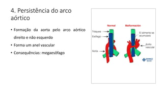 4. Persistência do arco
aórtico
• Formação da aorta pelo arco aórtico
direito e não esquerdo
• Forma um anel vascular
• Consequências: megaesôfago
 