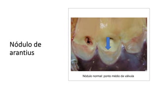 Nódulo normal: ponto médio da válvula
 