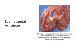 Tumefação por líquido edematoso claro - mais agudo
Causa desaceleração do fluxo sanguíneo no
momento da morte ou morte agônica prolongada
Diferenciar de endocardiose
 